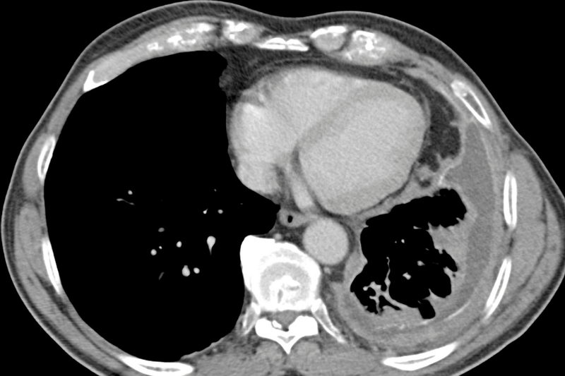 Axial CT scan through the thorax after intravenous contrast showing the complications which may occur with asbestos exposure. There is extensive left pleural thickening and left pleural fluid due to advanced mesothelioma